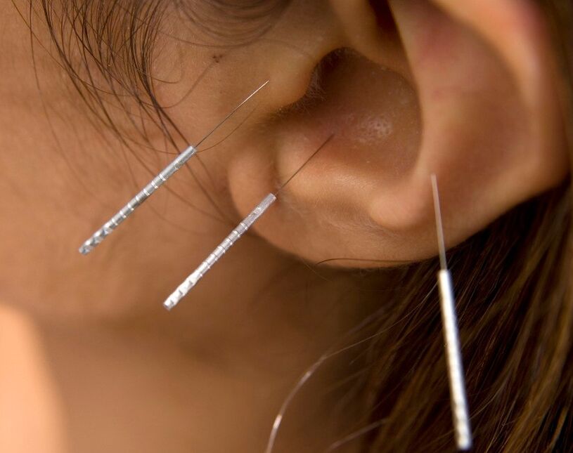 Akupunktur sigarayı bırakmanın yollarından biridir